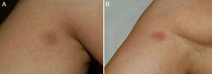 A, Round, well-demarcated, brownish-grayish macular lesions measuring 2cm in diameter on the anteromedial aspect of the right arm. B, The lesions worsened after an oral challenge test, acquiring a reddish-violaceous color.