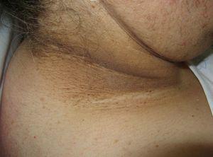 Acanthosis nigricans (hyperpigmentation on the neck).
