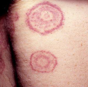 Erythema gyratum repens (concentric rings).