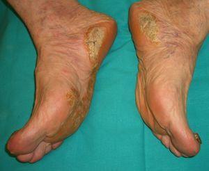 Paraneoplastic acrokeratosis of Bazex (plantar hyperkeratosis and nail dystrophy).