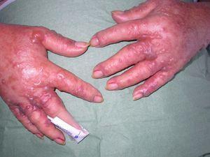 Tense blisters filled with clear fluid on the dorsum of the hands.