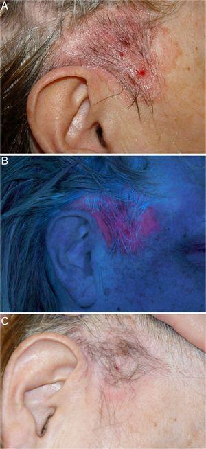 A, Erythematous plaque measuring 5cm located in the right temporal region and extending towards preauricular hairless skin, with a periphery marked by linear pigmentation. B, Plaque displaying intense red fluorescence after a 3-hour incubation period with methyl aminolevulinate. C, Complete remission 2 months after the second photodynamic therapy session.