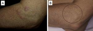 A, Patient with clonal pseudolymphoma. B, After 4 sessions of rituximab; the patient was asymptomatic 2 years later.