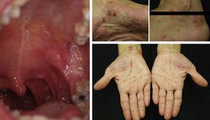 Generalized vesicular-bullous lesions in a patient with acquired bullous epidermolysis. Combination of intermediate-dose corticosteroids and rituximab led to disease control, and conversion to negative anticollagen vii antibody status in 6 months.