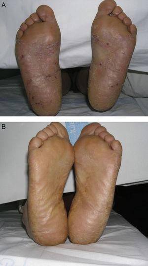 Example of a patient with plantar psoriasis. A, Prior to treatment. B, After treatment.