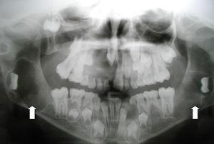 Case 1. Panoramic radiograph of the maxilla: odontogenic keratocysts.