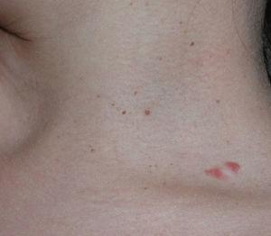 Case 2. Brownish papules (3 to 5mm in diameter) corresponding to BCCs on the side of the neck.