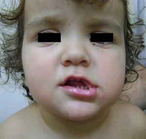 Case 3. Peculiar phenotype with BCCs on the face.