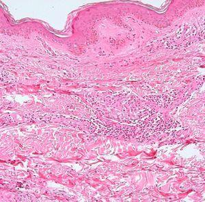 Tuberculoid leprosy. Granulomatous inflammation in the dermis is composed of epithelioid cells surrounded by T cells. Hematoxylin-eosin, original magnification ×100.