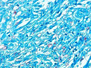 Abundance of acid-alcohol-fast bacilli in lepromatous leprosy. Fite-Faraco, original magnification ×400.