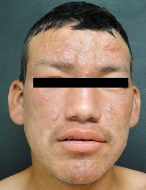 Typical leonine facies in lepromatous leprosy.