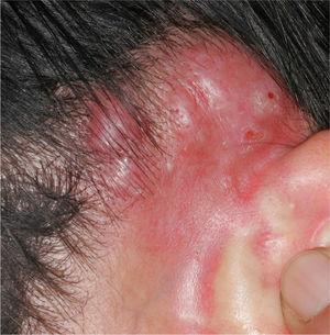 Papules with a tendency coalesce and form plaques in the retroauricular region (case 3).