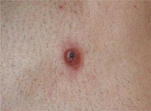 Erythematous papule with a superficial scab, located on the shoulder (case 4).