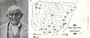 Leprosy. A, Patient with leonine facies. B, Map of Spain showing the number of officially registered cases of leprosy in 1932. Cases were concentrated in 3 areas of peninsular Spain: the northwest, the southeastern coast, and Andalusia. Another focus of disease was the Canary Islands.