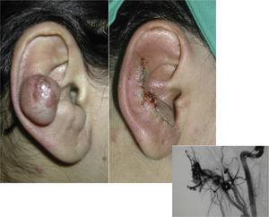 Ateriovenous malformation. Surgical treatment.