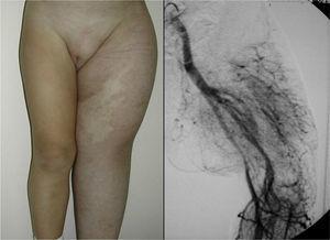 Parkes-Weber syndrome: generalized hypertrophy of a limb associated with an arteriovenous malformation.