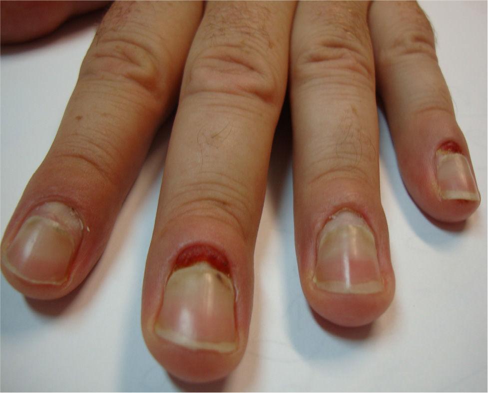 pyogenic granuloma finger