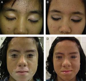 A and B. Segmental vitiligo before and after the camouflage session. C and D. Segmental vitiligo before and after the camouflage session.