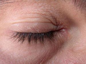 Mild allergic contact eczema of the eyelids after application of a cosmetic product.