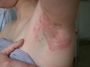 Allergic contact eczema in the armpit caused by a Lyral-containing deodorant.