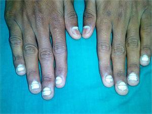 Idiopathic acquired leukonychia totalis of the fingernails in a 10-year old child.