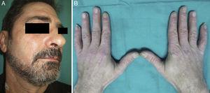 A, Resolution of the facial rash following treatment with rituximab. B, Appearance of hands after treatment.
