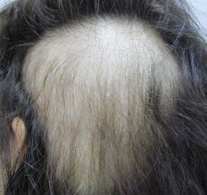 Clinical image of the alopecia lesion. A plaque of alopecia with a rectangular morphology and well-defined borders in the left parieto-occipital region 1 month after the intervention and presented a rectangular morphology with well-defined borders.