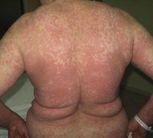 Maculopapular exanthema, type iv hypersensitivity reaction, the most frequent type of cutaneous drug reaction.