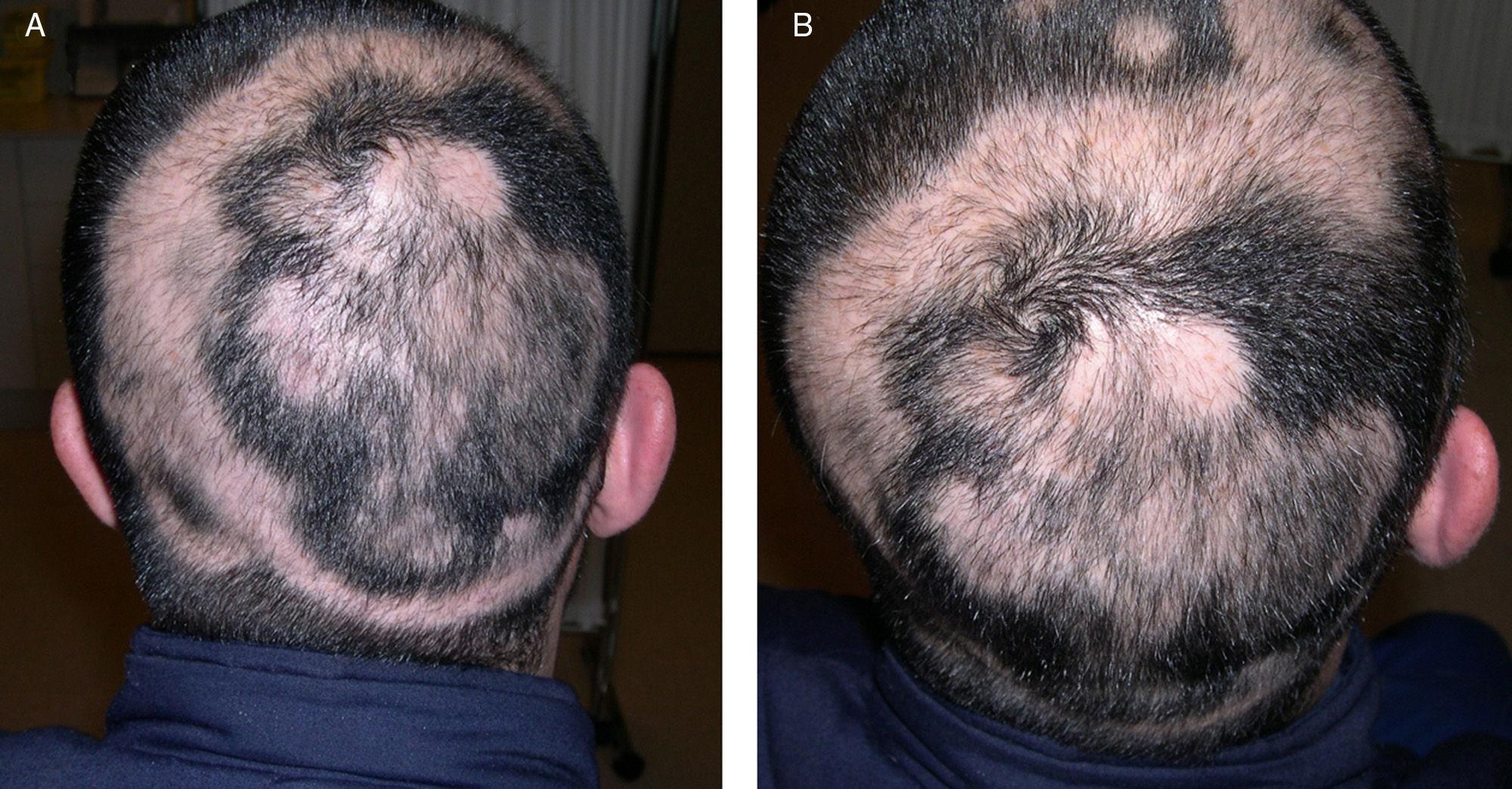 Alopecia Treatments: Approved and Upcoming Medications - GoodRx