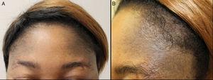A and B, Multiple, confluent macules measuring a few millimeters in diameter, forming a poorly-defined, bluish-gray macule of mottled appearance on the forehead and extending into both parietal regions.