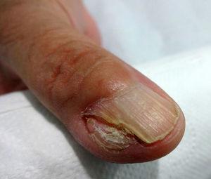 Clinical photograph of the keratoacanthoma. The nodular, skin-colored lesion affected the proximal and ulnar borders of the nail and periungual region of the right thumb.