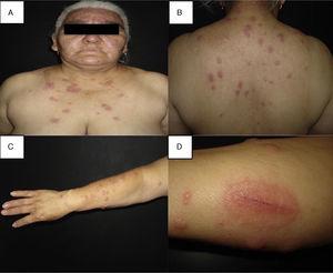 (A–C) Disseminated dermatosis affecting the face, upper trunk and four limbs, predominantly on sun-exposed areas, bilateral and prone to symmetry, polymorphous, characterized by erythematous, thick, sharply demarcated nodules and plaques, and some yellow pustules between them. (D) Pathergy phenomenon.