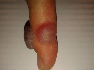 Blood-filled blisters after cryotherapy applied to 2 warts located on the lateral and dorsal aspect of a finger.