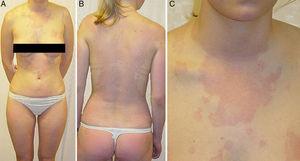 A and B, Generalized erythematous rash mainly affecting the face (not shown in the image) and the trunk of the patient.11 C, Detailed view of the upper thorax. Note the absence of whealing. Reproduced with permission from Jantschitsch et al.11