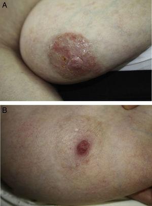 A, Well-defined, flaking, exudative erythematous plaque in the areola of the right breast. B, Complete resolution of the lesion in the areola of the right breast after 6 months of topical therapy.