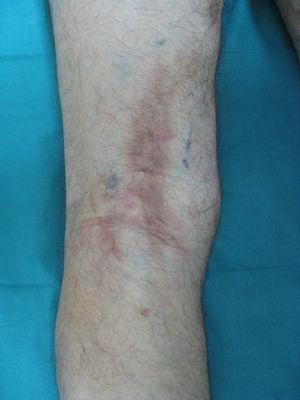 Indurated, hyperpigmented linear plaque in the right popliteal fossa.