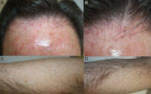 A, Hairline that is evidently receding from the forehead in a patient with no underlying androgenetic alopecia. B, Intense erythema and perifollicular hyperkeratosis. C and D, Bald patches on both arms.