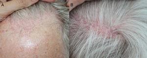A, Receding hairline with erythema and perifollicular hyperkeratosis. B, Patches of parietal scarring alopecia typical of follicular lichen planus.