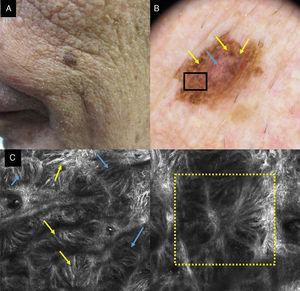 A, Clinical image showing a pigmented lesion on an 80-year-old man. B, Dermoscopic lesion with abundant blue-gray rhomboid structures (yellow arrows) and vascularization (blue arrow). C, CRM image corresponding to the area of the 1×1mm black box in the dermoscopic image, showing the dermal-epidermal junction broadening with atypical cells (yellow arrows); the localization of the dendritic cells, forming bridges that constitute the structures that simulate mitochondria (blue arrows) can also be seen. D, CRM image of 1×1mm in which their follicular localization can be seen with a tentacle-like appearance (yellow box).