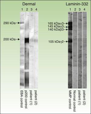 Immunoblot technique performed with dermal extracts of human skin, obtained by splitting skin with ethylenediamine tetraacetic acid and submitting to electrophoresis on SDS-polyacrylamide gel, as per the Laemmli method (left) as well as immunoblotting with recombinant laminin 332 (right). As shown in the left panel (dermal extracts of human skin), sera of patients 1 and 2 (corresponding to columns 3 and 4, respectively) show a band at 200kDa, corresponding to the same band present in the serum of another patient with anti-p200 pemphigoid (column 2). This band is not present in the serum of a patient with epidermolysis bullosa acquisita (column 1), but a band is present at 290kDa, corresponding to collagen vii. In the right panel (recombinant laminin 332), the recombinant protein is not detected in the sera of patients 1 and 2 (columns 3 and 4, respectively) and the serum from healthy control (column 2), whereas the serum of a patient with anti-laminin 332 pemphigoid (column 1) has several bands at 165, 145, 140, and 105 140kDa, corresponding to the α3, β3, and γ2 chains of laminin 332, respectively.