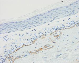 Immunohistochemical study with collagen iv, showing staining of the dermal part of the blister, thus demonstrating that the collagen is above the lamina densa, as well as the wall of dermal vessels (collagen iv ×200).