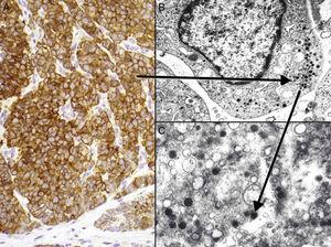 Immunohistochemistry of Merkel cell carcinoma. A, Immunohistochemical staining with chromogranin for neuroendocrine differentiation showing the characteristic granular pattern in the cytoplasm. B and C, Electron microscopic images showing electron-dense granules dispersed in the cytoplasm of cells from a Merkel cell tumor.