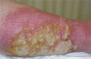 Hot erythematous plaque on a leg, with blister formation and an abundant exudate.