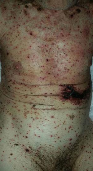 Disseminated herpes zoster lesions with marked necrosis in an immunocompromised patient.