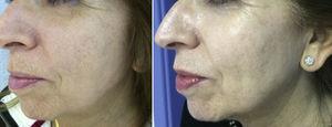 Photos at baseline and 10 days after a ZO 3-Step peel. Changes include increased luminosity, uniformity of skin color, and improved skin texture.