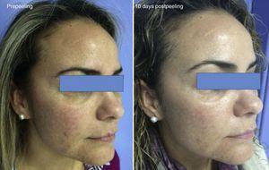 Melasma. Improvement produced by a reduction in pigmentation and in variability of skin color 10 days after performing the peel.