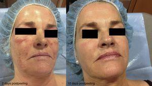 Photoaging. Changes after a ZO 3-Step peel.