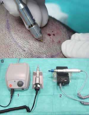 FUE systems. A, Manual punch. Extraction of the follicular unit requires alignment of the punch with the angle and direction of emergence of the hair shaft, which must be kept in the center of the punch. B, Two motorized systems: the SAFE device by Harris (HSC Development, Colorado, US) (1) and the Vortex device by Cole (Cole Instruments, Georgia, US) (2).