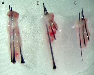 Follicular units. A, Normal, undamaged. B, Partial transection of 2 follicles. C, Complete transection of the follicular unit.