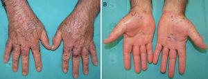 A and B, Macules, papules, and a hemorrhagic blister on the back of hands, the palms, and the wrists.